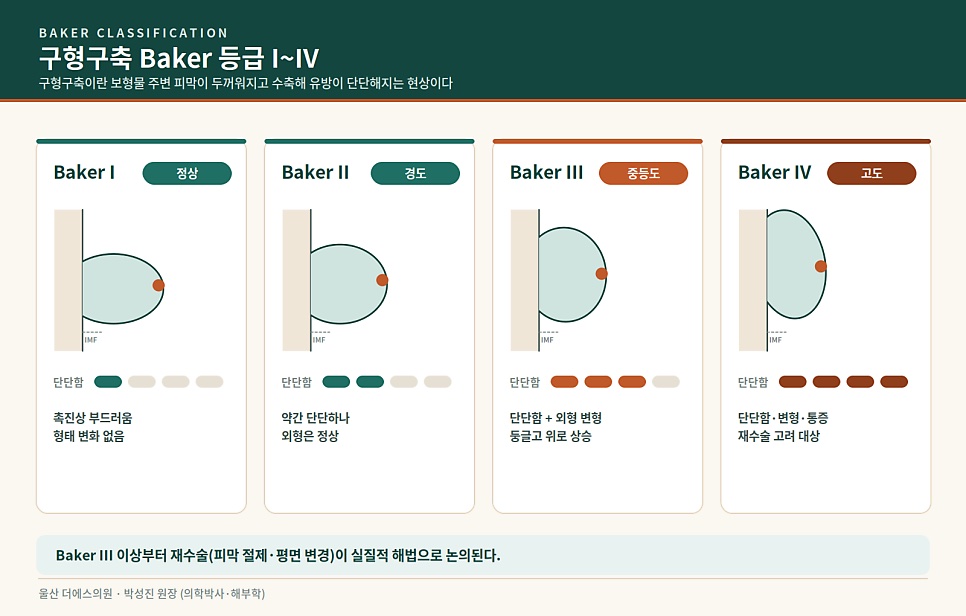 가슴 재수술