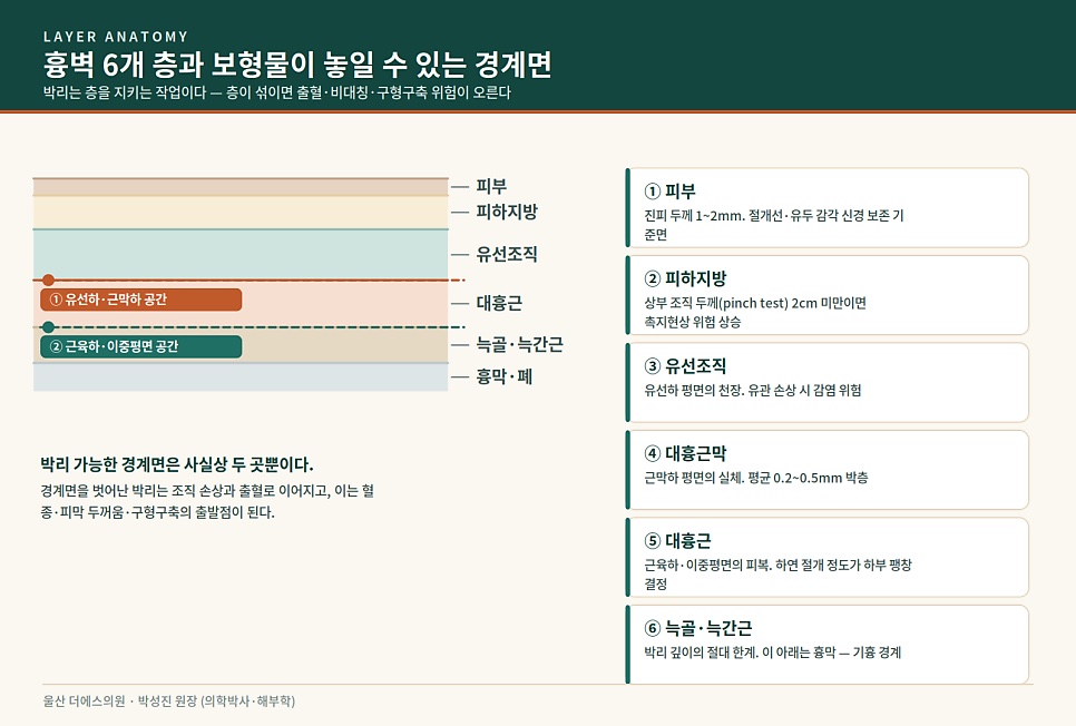 흉벽 6개 층과 보형물이 놓일 수 있는 경계면