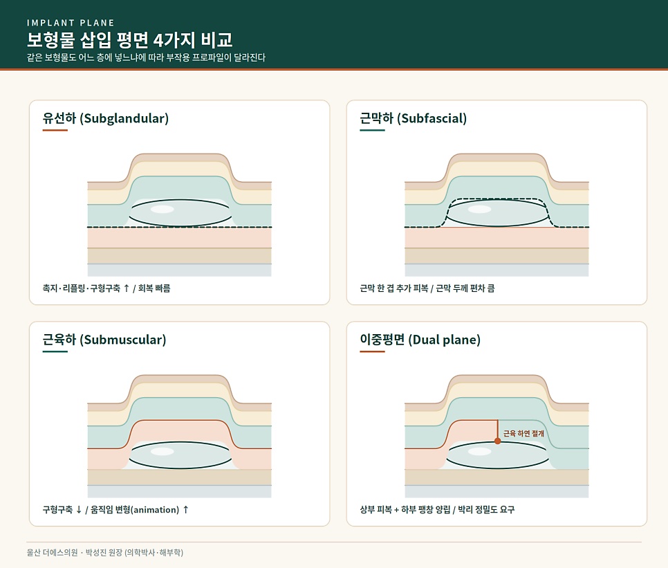 가슴확대