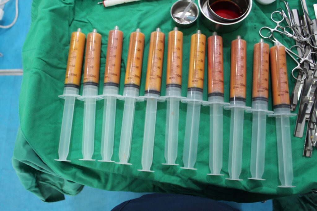 팻셀 지방흡입주사로 뽑아낸 지방 (실제 시술 사진)